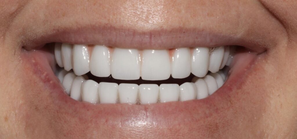 Affordable Smile Makeovers in Baton Rouge