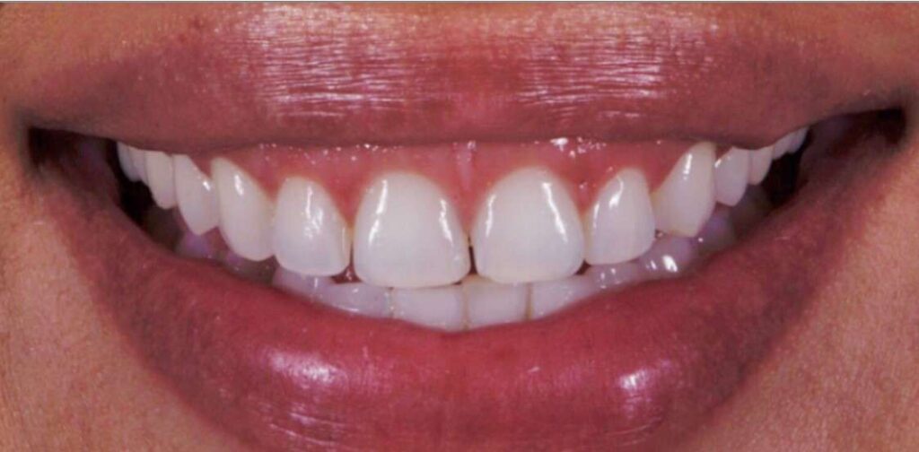 Porcelain Veneers in Baton Rouge